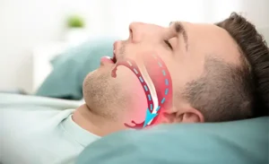 Sleep Apnea